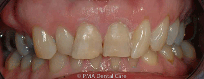 invisalign case before picture