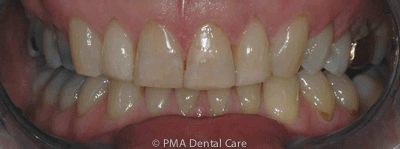 Invisalign Before and After - 29 Aligners “gravesend invisalign braces before and after picture