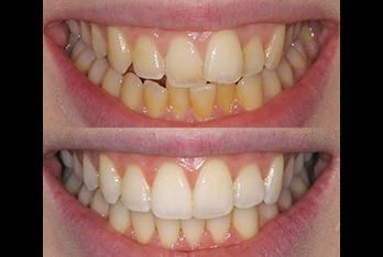 Inman Aligner Case Inman aligner 9 weeks before and after