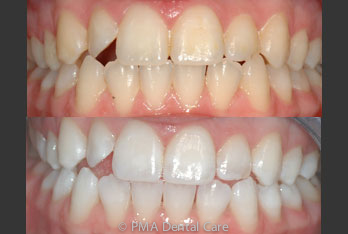 Before and After Enlighten Teeth Whitening Before and After Enlighten Teeth Whitening Gravesend