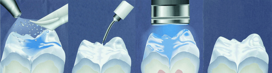 Fissure Sealants fissure sealant example