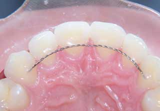 fixed retainer