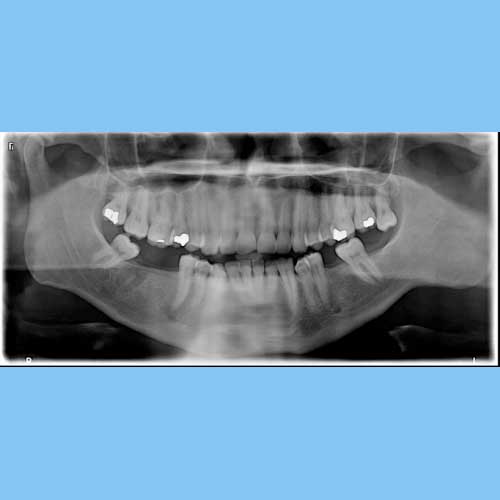 Dental Digital X-Rays