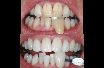 Enlighten Teeth Whitening