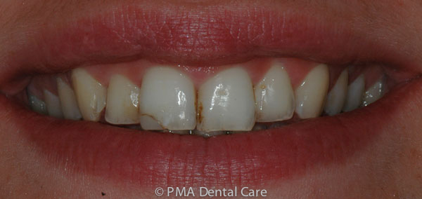 chipped discoloured teeth before