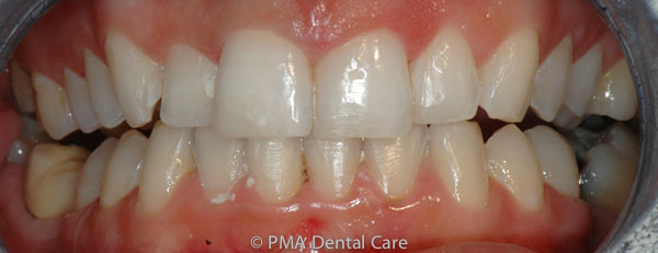 whitening and chipped teeth blog case after treatment