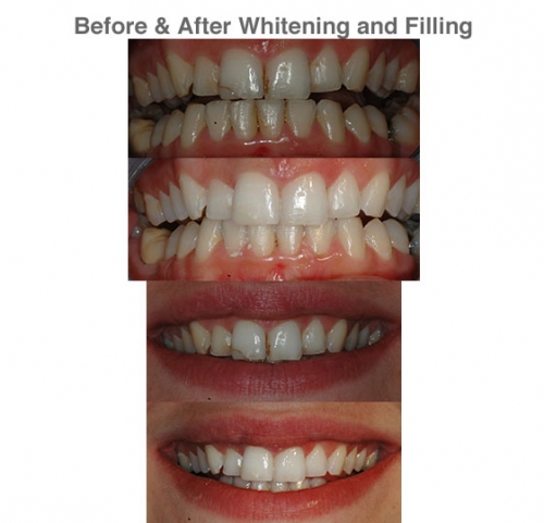 White Teeth and White Fillings