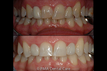 Invisalign crowns teeth whitening