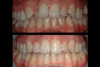 Invisalign before and after