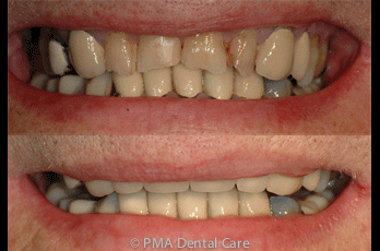 bonded white crowns
