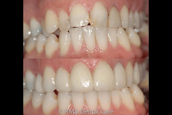 before and after crowns and veneers
