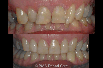 Invisalign Before and After - 29 Aligners