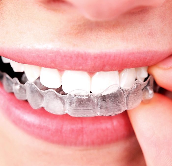 Maintaining Your Post-Invisalign Aligner Smile