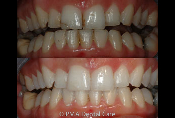 chipped discoloured teeth before and after