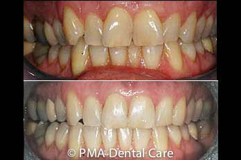 Invisalign smile before and after 6 months